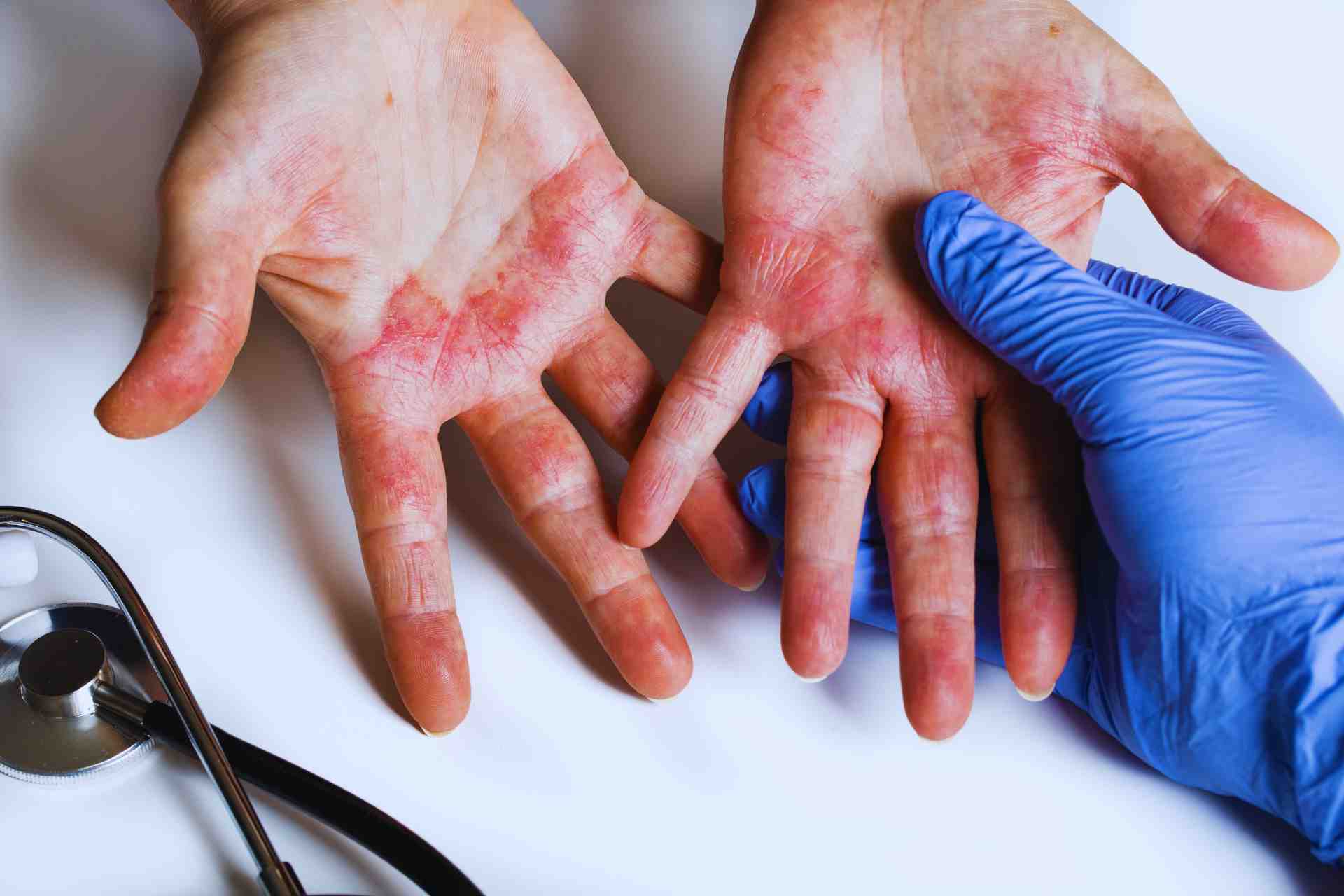 Especialista en dermatitis atópica en Naucalpan