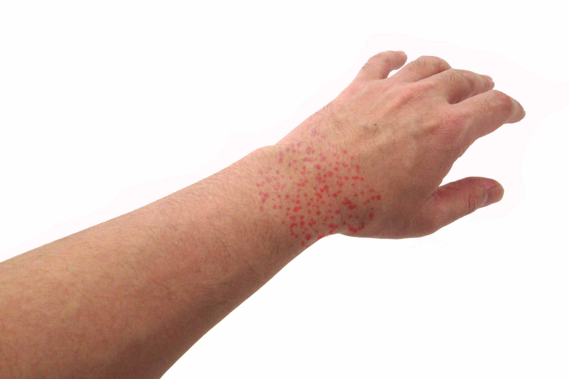 Especialista en urticaria en Naucalpan