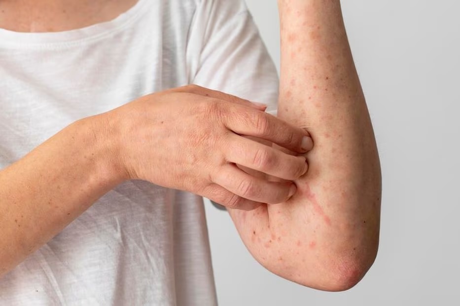 Especialista y Tratamiento de la Urticaria Crónica en Naucalpan